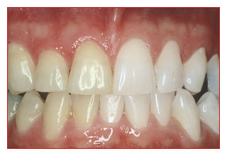 Bleaching-Ergebnis vorher/nachher